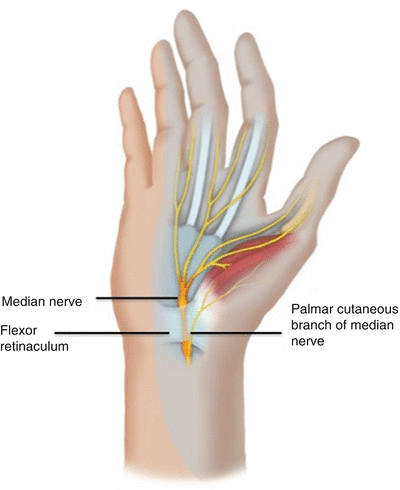 Carpal Tunnel Injection Springerlink