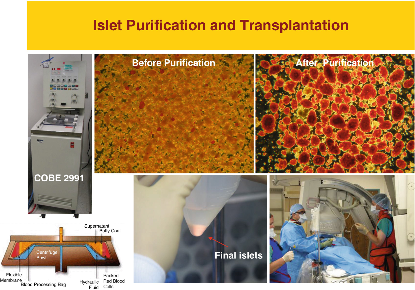 Islet Cell Transplant Springerlink Islet Cell Transplant Springerlink