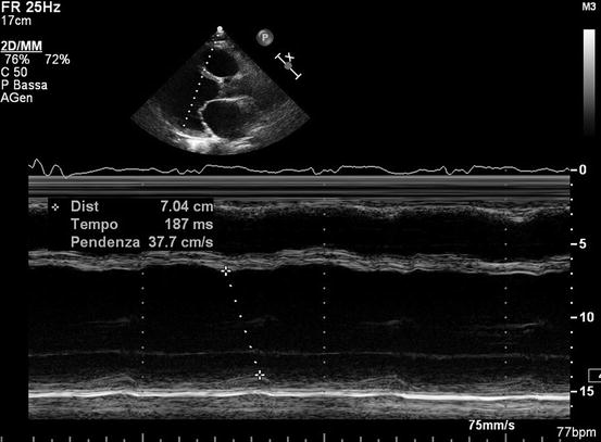 Basic Echocardiography in Dilated Cardiomyopathy | SpringerLink
