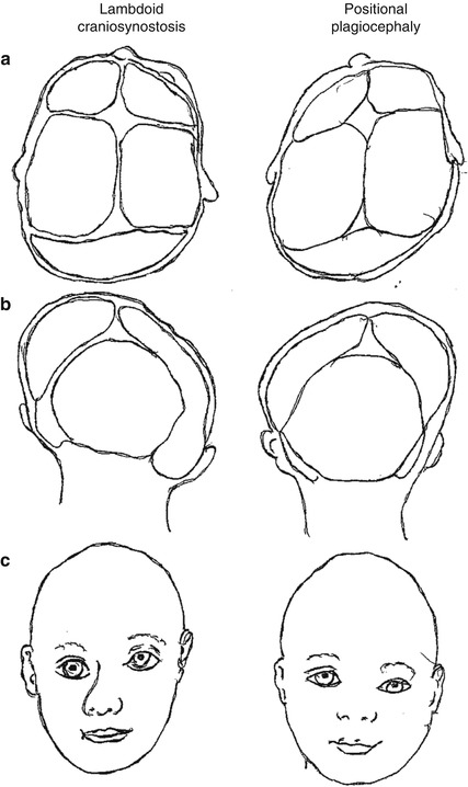 left plagiocephaly