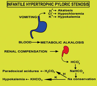 Pathophysiology of pyloric stenosis