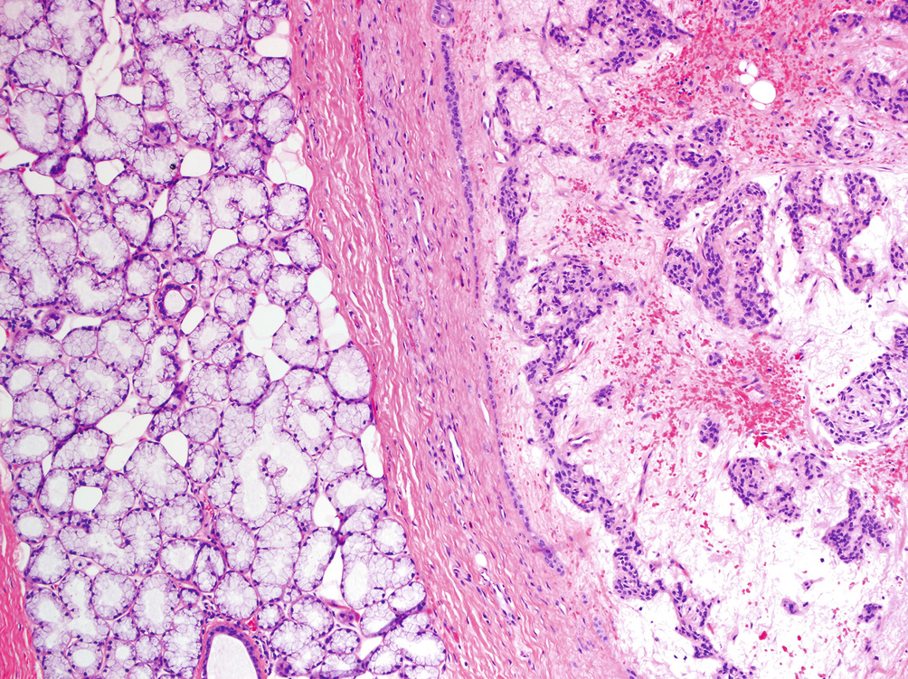 Neoplasma benignum seromucinosus laryngis