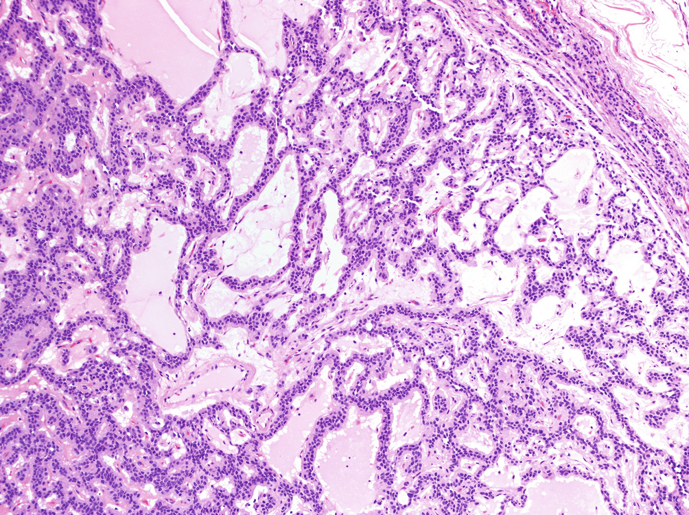 pleomorphic adenoma pathology