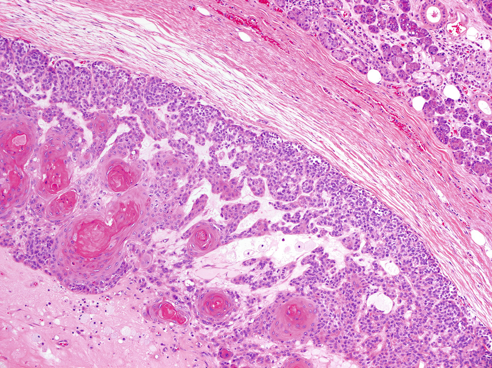 Neoplasma benignum seromucinosus laryngis