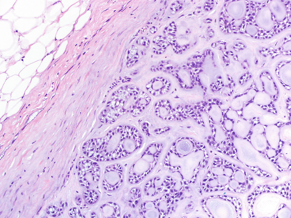 adenoid cystic carcinoma