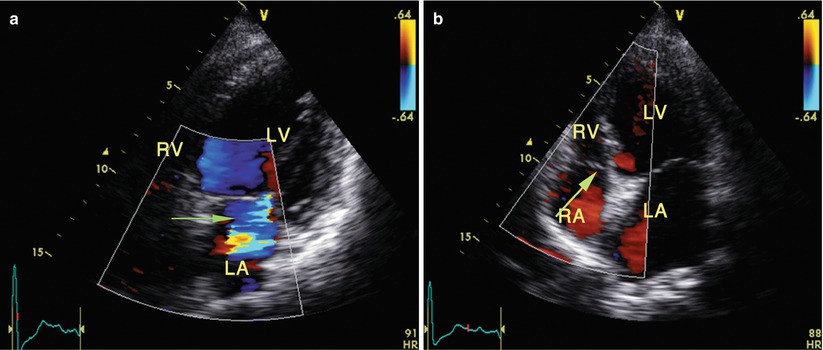 Situs Inversus Dextrocardia Springerlink Situs Inversus Dextrocardia Springerlink