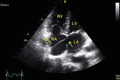 Atrial Septal Defect Ostium Secundum Type Attached To The Coronary Sinus Springerlink
