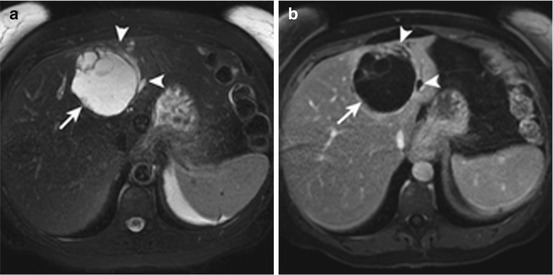 adenoma and biliary cystadenoma springerlink biliary cystadenoma