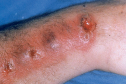 Sporotrichosis | SpringerLink