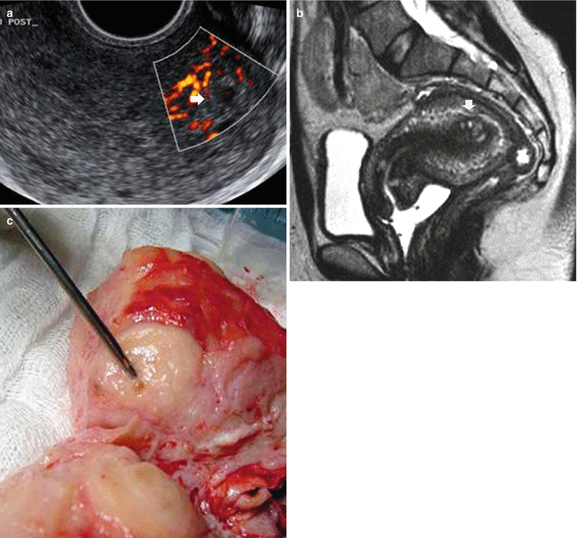 Adenomyosis Springerlink