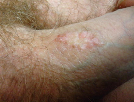 Papilloma vírus keratosis - Bőrhibák kezelése
