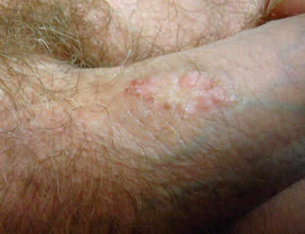 papilloma vírus keratosis)