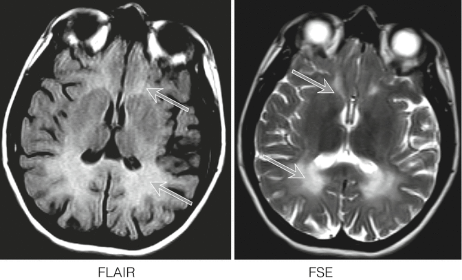 Phenylketonuria: Phenylalanine Neurotoxicity | SpringerLink