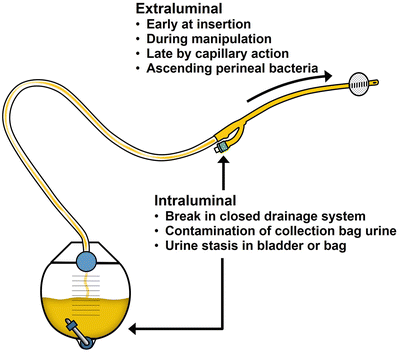 Indwelling (Transurethral and Suprapubic) Catheters | SpringerLink