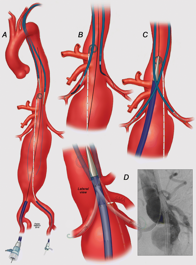 Parallel Graft Techniques to Treat Complex Aortic Aneurysms Involving ...