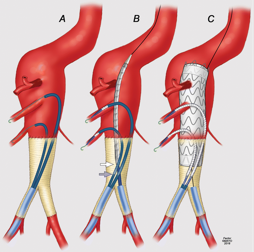 Parallel Graft Techniques to Treat Complex Aortic Aneurysms Involving ...
