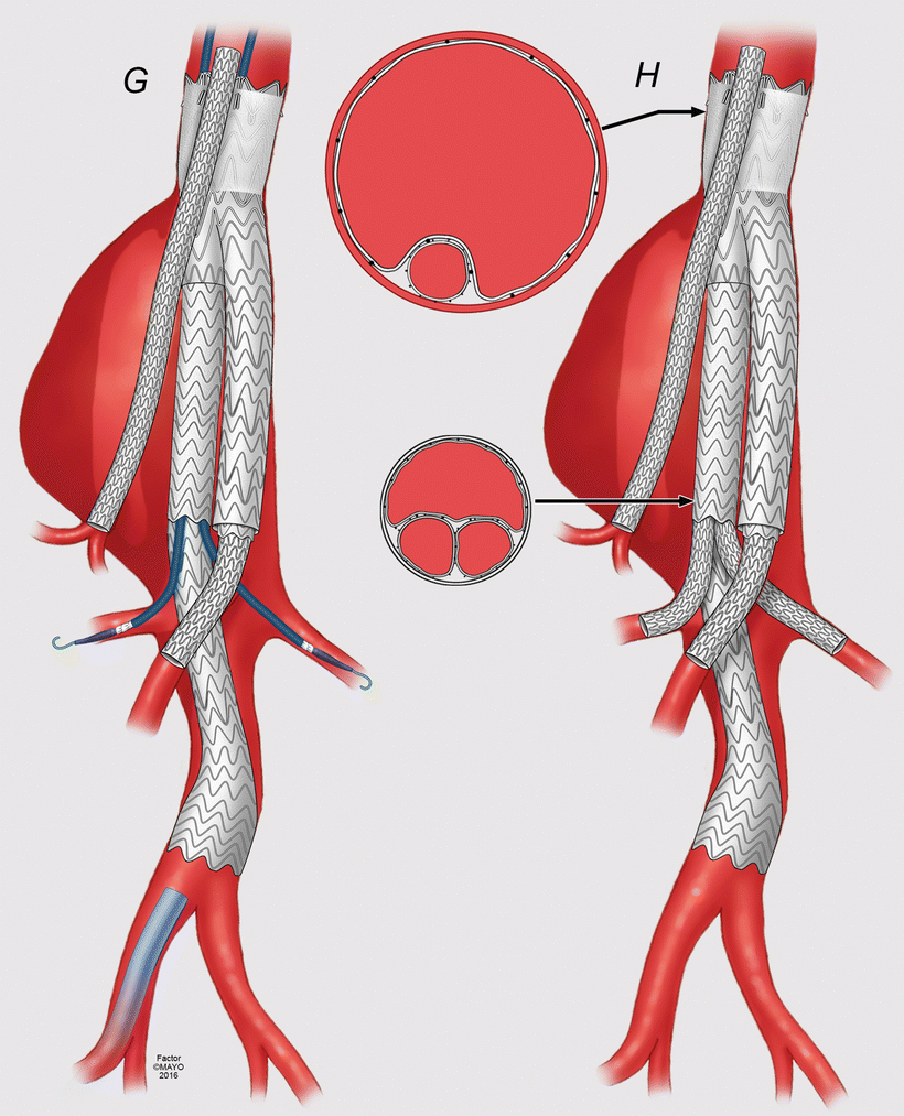 Parallel Graft Techniques to Treat Complex Aortic Aneurysms Involving