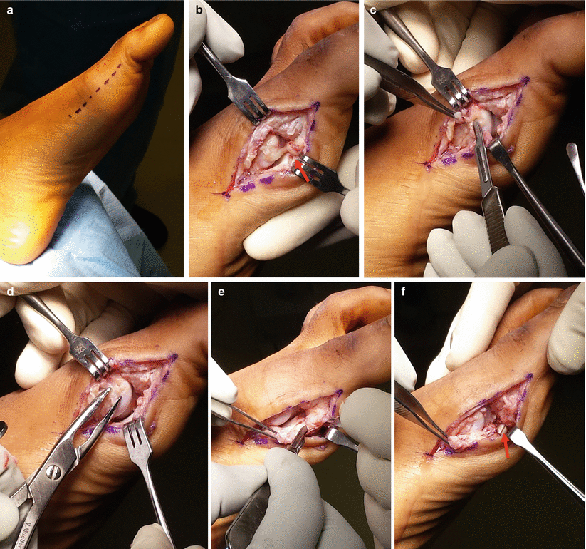 Sesamoid and Capsule Lesions of the First