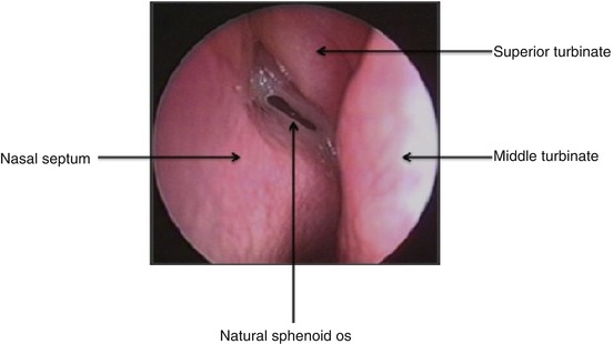 Surgery For Sphenoid Sinus Disease Springerlink