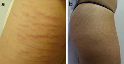 Microneedling for Transepidermal Drug Delivery on Stretch Marks ...