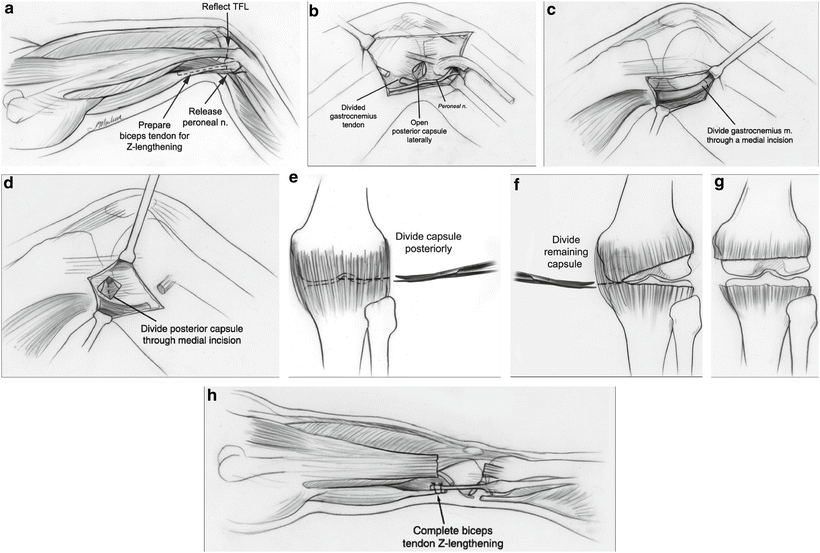 Congenital Femoral Deficiency Reconstruction And Lengthening