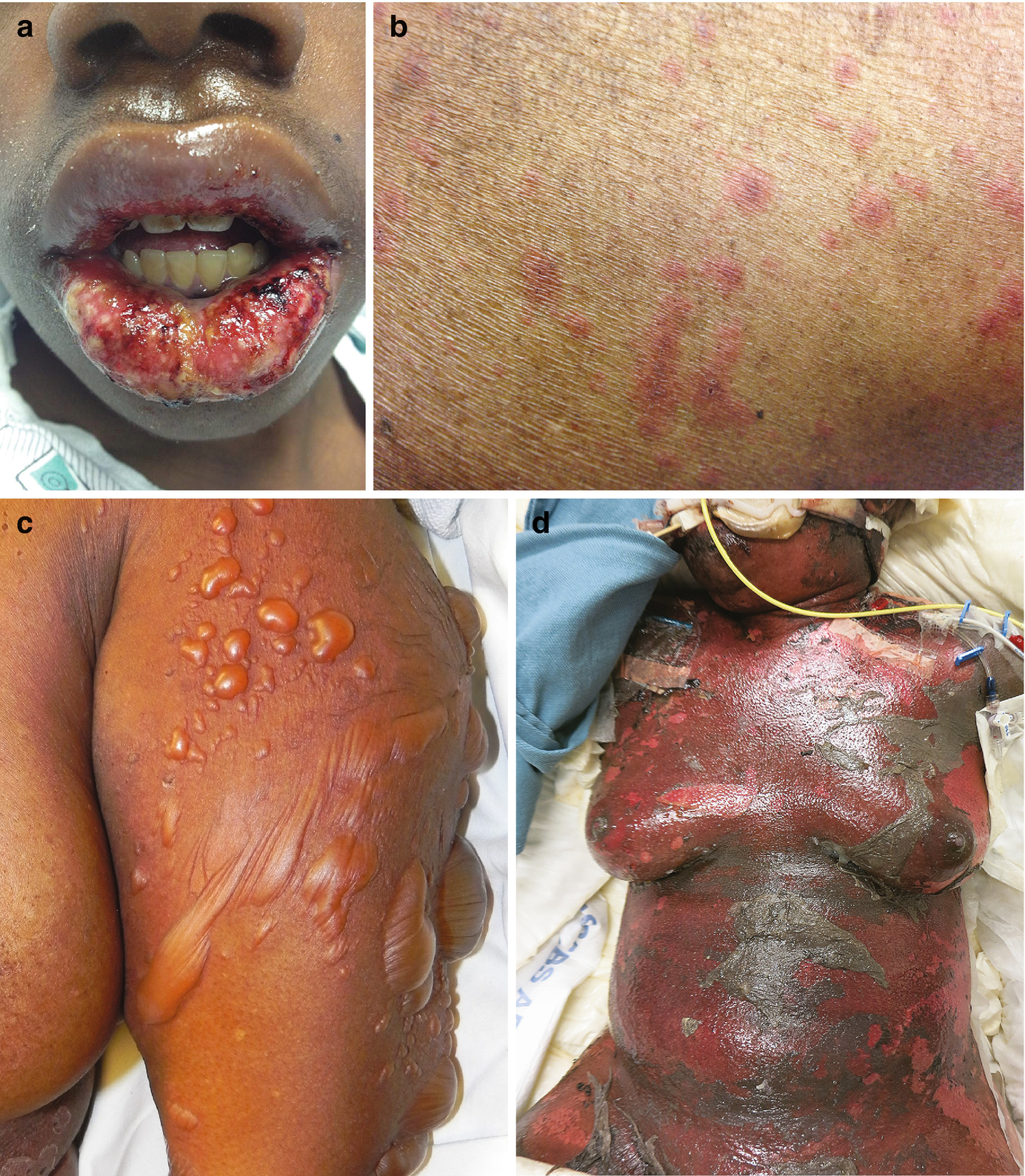 Stephen Johnson Syndrom : A Review Of Causes Of Stevens Johnson Syndrome And Toxic Epidermal Necrolysis In Children Archives Of Disease In Childhood - Treatment focuses on removing the cause, caring for wounds, controlling pain and minimizing complications as.