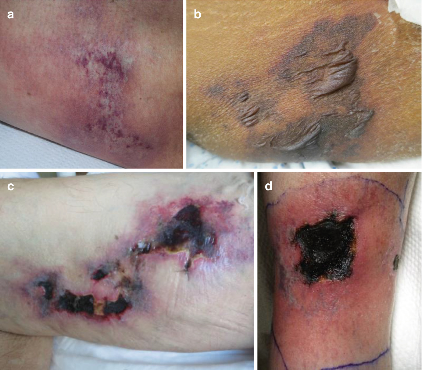 nonuremic calciphylaxis