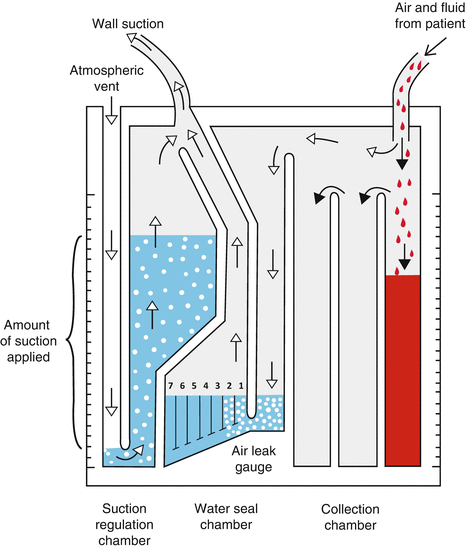 Postoperative Care Including Chest Tube Management Springerlink