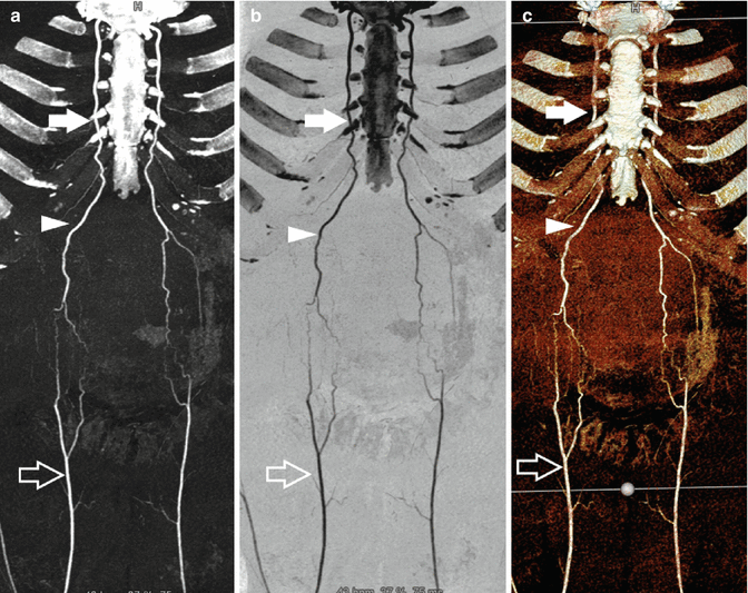 pix Internal Mammary Artery Anatomy internal mammary artery
