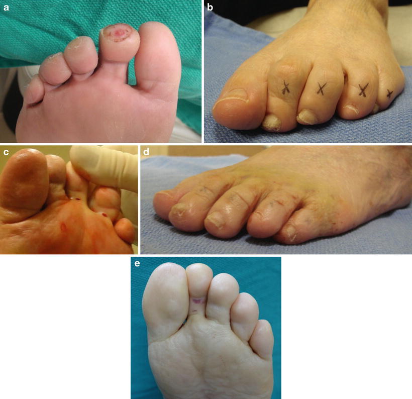 Osteomyelitis of the Central Toes SpringerLink