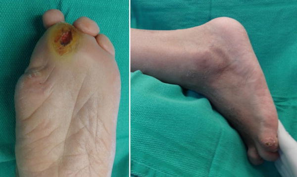 Central Metatarsal Osteomyelitis | SpringerLink