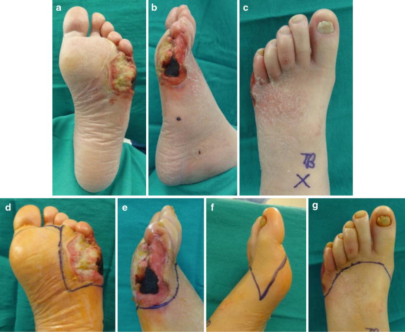 Fifth Ray Osteomyelitis Springerlink