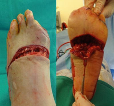 Transmetatarsal and Lisfranc Amputation | SpringerLink