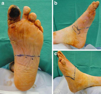 Chopart S Amputation For Osteomyelitis Of The Midfoot Springerlink