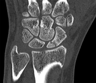 1,2 ICSRA for the Management of Proximal Pole Scaphoid Nonunion ...