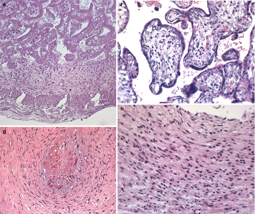 Macerated Stillbirth SpringerLink