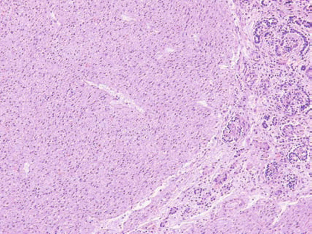 Congenital Tumors Springerlink