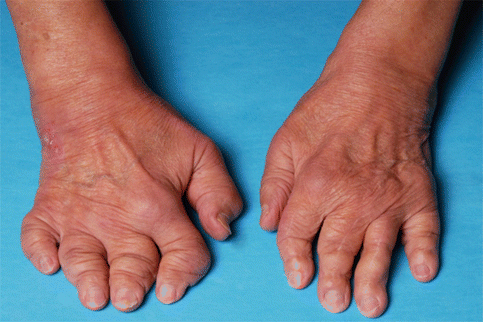 Psoriatic Arthritis