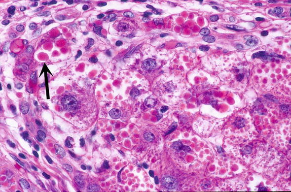 Patterns Of Liver Injury Springerlink