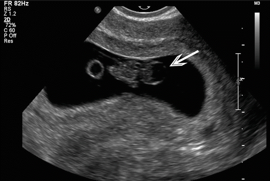 Trimester normal ultrasound first Introduction to
