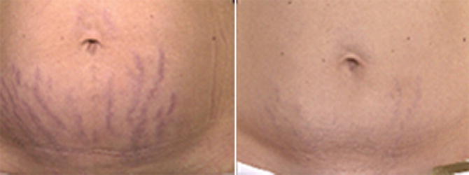 CO2 Laser for Stretch Marks | SpringerLink