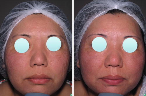 Glycolic Acid Peel Springerlink - 