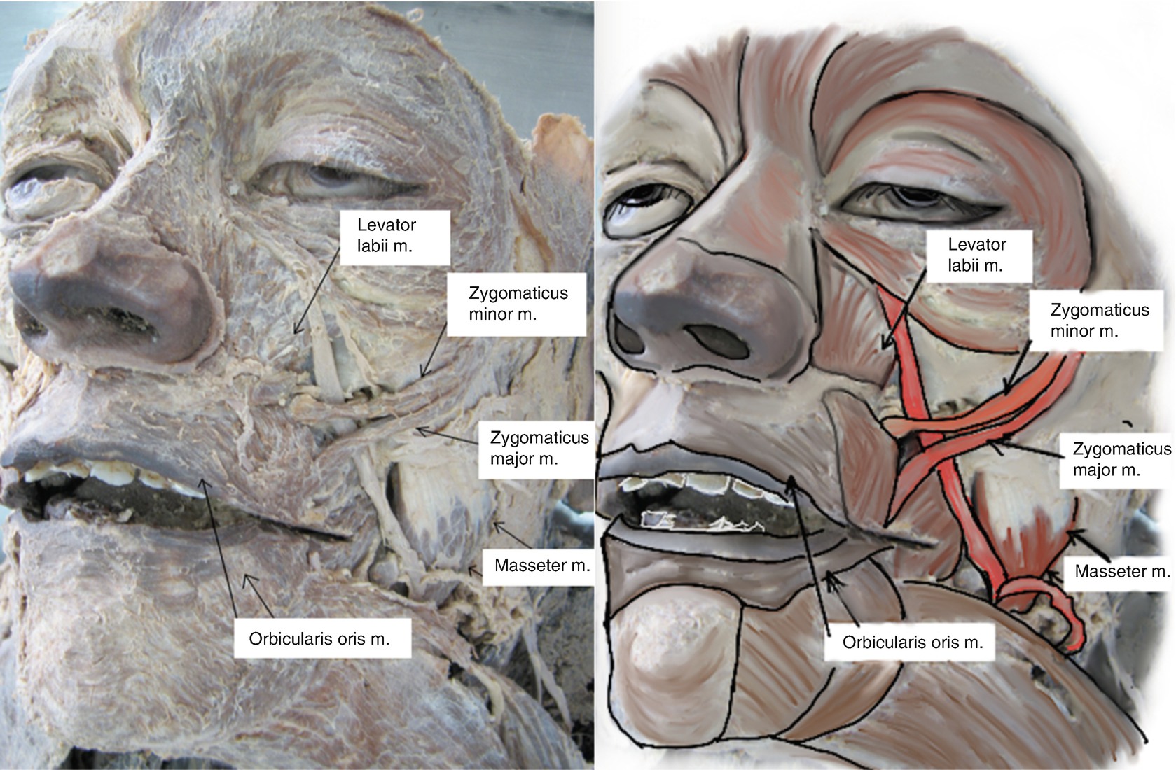 Facial Anatomy View for Aesthetic Fillers Injections | SpringerLink