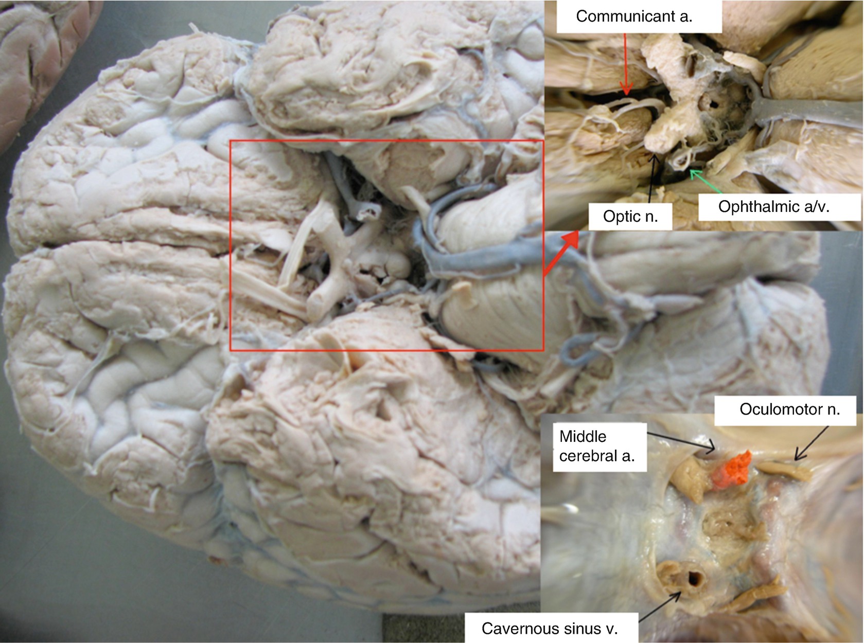 Facial Anatomy View For Aesthetic Fillers Injections Springerlink