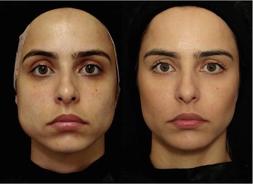 Three Dimensional Approach Of Cosmetic Patient Aging Gracefully