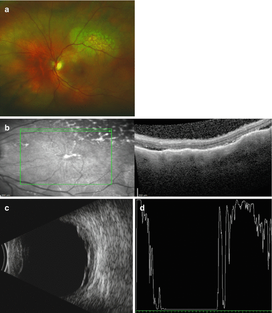 Choroidal Metastases Springerlink - 