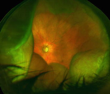 Fig 551 Fundus Image Showing Choroidal Detachment Fig 551 Fundus Image Showing Choroidal Detachment