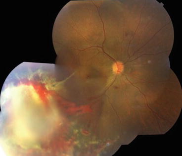 Fig 61 Acute Appearance Of Chorioretinitis Sclopetaria Fig 61 Acute Appearance Of Chorioretinitis Sclopetaria