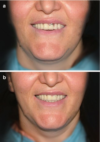 Dentures At 32  - No Slip, No Slide, Denture Demo.