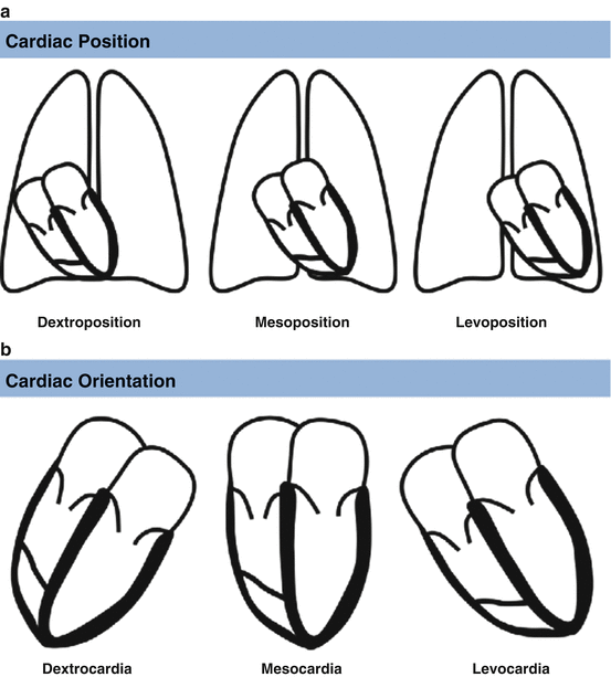 Basic Adult Congenital Heart Disease (ACHD) | SpringerLink